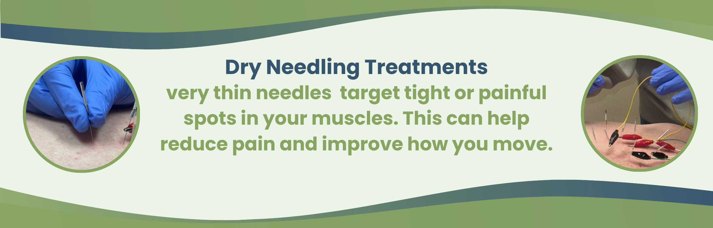 Dry Needling Treatments Very thin needles  target tight or painful spots in your muscles. This can help reduce pain and improve how you move.